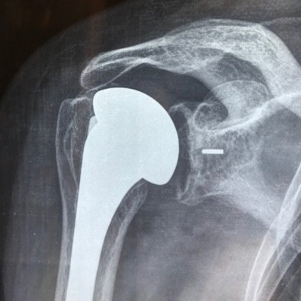 Cirugía de Prótesis de Hombro en Santa Cruz